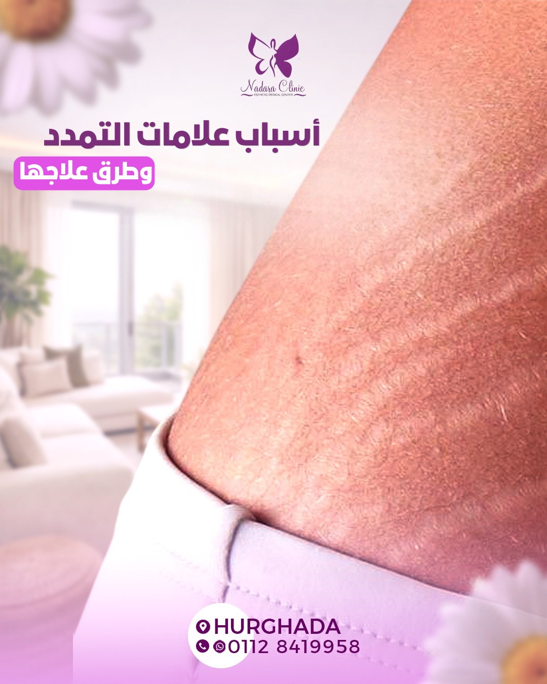 أسباب علامات التمدد وطرق علاجها في الغردقة